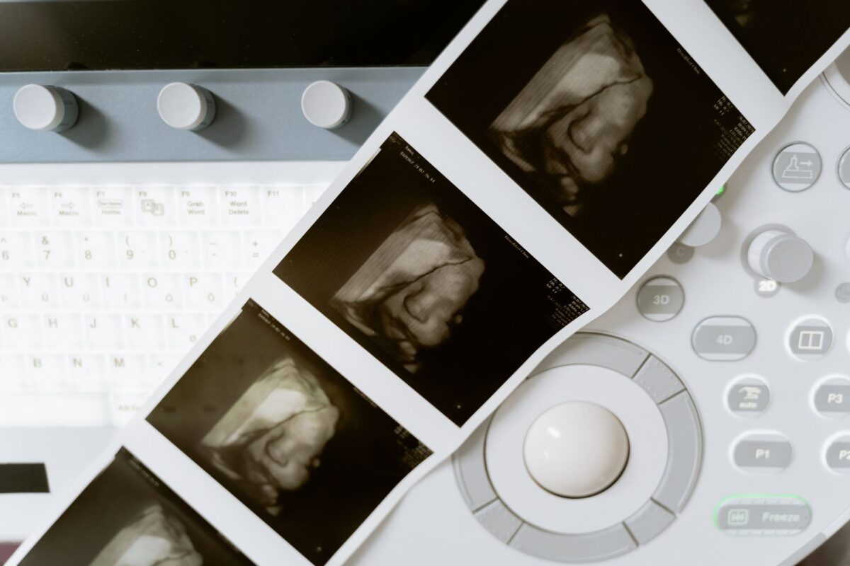 bladder scan comprendre sert mesure résidu